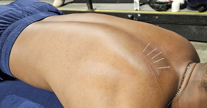 Dry Needling